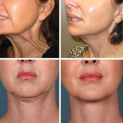 💖 REAFIRMA, HIDRATA Y REJUVENECE TU CUELLO CON FIRMAGE NECK™ ✨